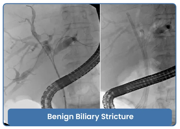 Benign Biliary Stricture