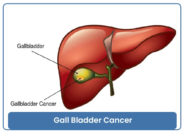 Gall Bladder Cancer