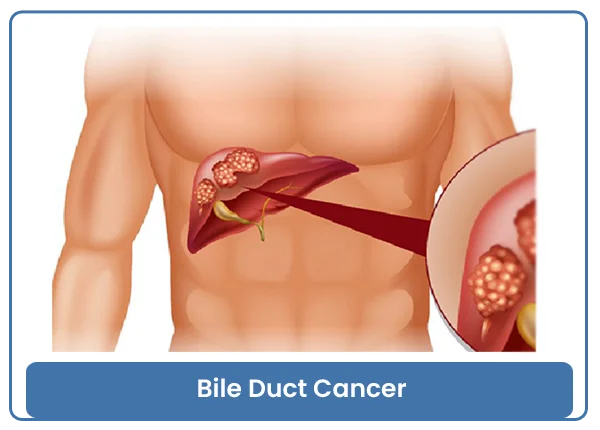 Bile Duct Cancer