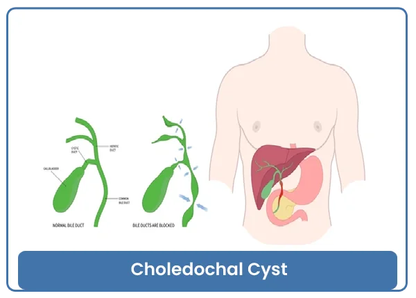 Choledochal Cyst