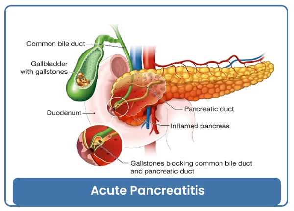 Acute Pancreatitis