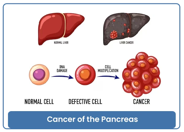 Cancer of the Pancreas