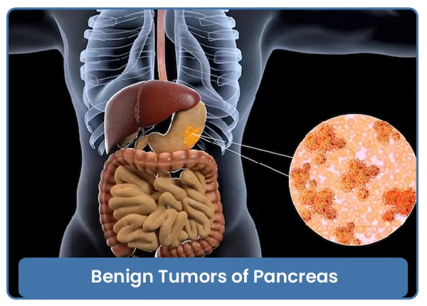 Benign Tumors of Pancreas