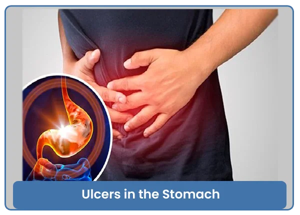 Ulcers in the Stomach