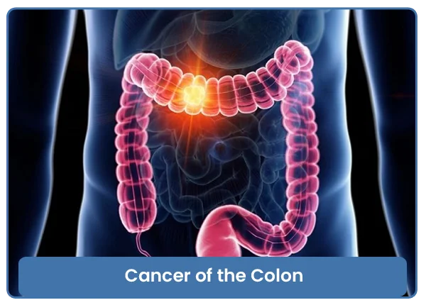 Cancer of the Colon