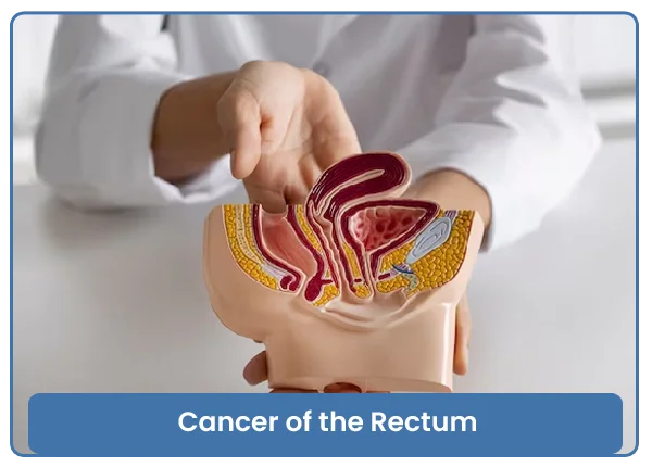 Cancer of the Rectum