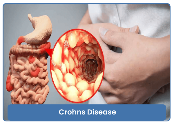 Crohns Disease