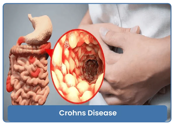 Crohns Disease