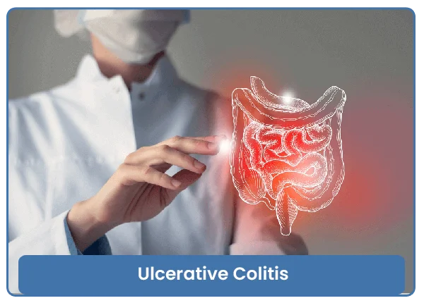 Ulcerative Colitis