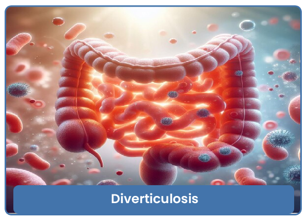 Diverticulosis