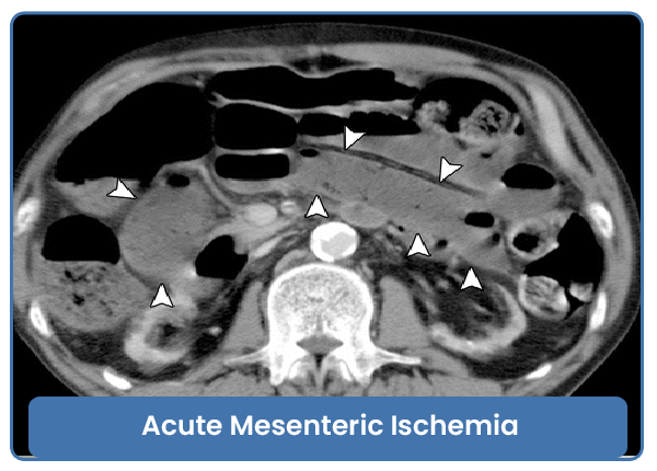 Acute Mesenteric Ischemia