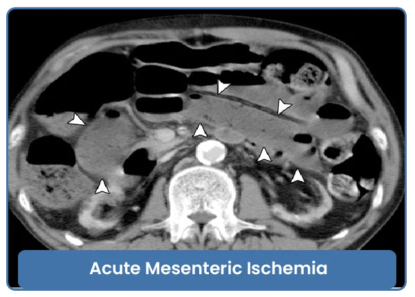 Acute Mesenteric Ischemia