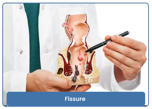 Fissure