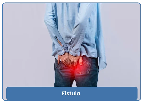 Fistula