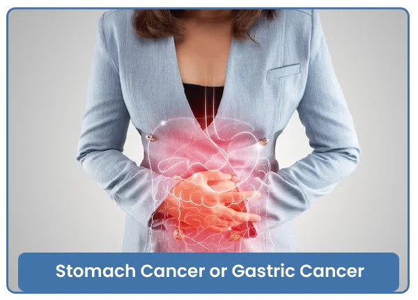 Cancer Of Stomach